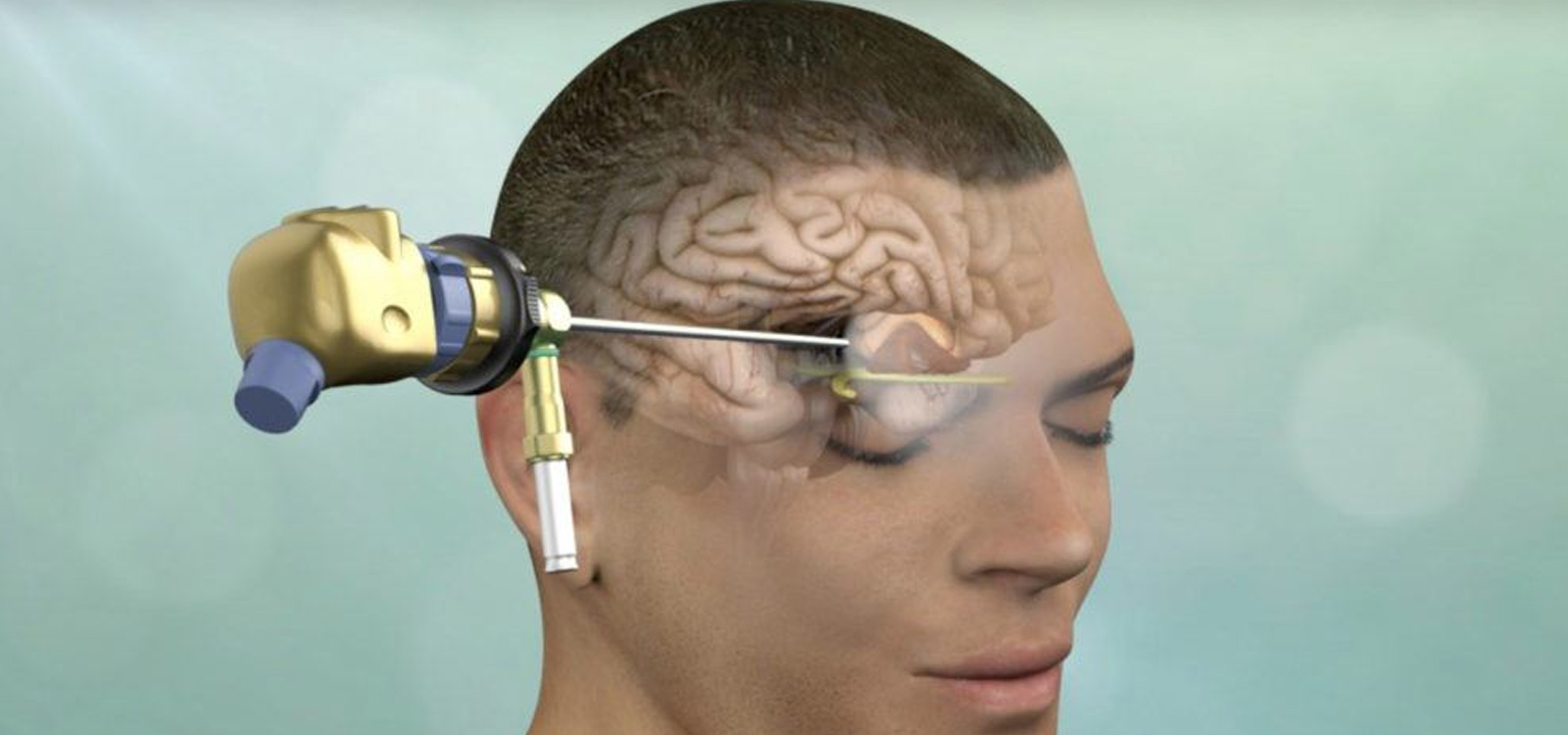 Endoscopic Brain Surgery in Delhi